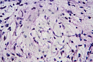 A neurofibroma tissue sample in neurofibromatosis genetic disease, light micrograph