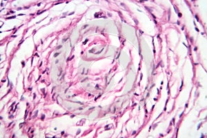 A neurofibroma tissue sample in neurofibromatosis genetic disease, light micrograph