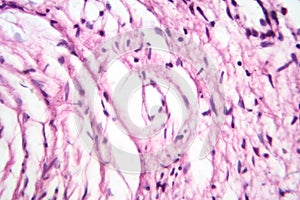 A neurofibroma tissue sample in neurofibromatosis genetic disease, light micrograph