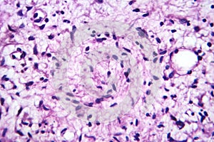 A neurofibroma tissue sample in neurofibromatosis genetic disease, light micrograph photo