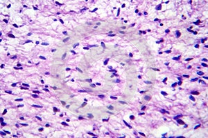 Neurofibromatosis, light micrograph, photo under microscope photo