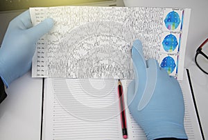 A neurologist examines an encephalogram of a patientÃ¢â¬â¢s brain. Schedule of electroencephalograms photo