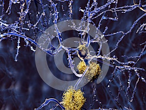 Neuron with amyloid plaques photo