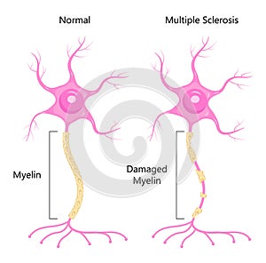 Neuron concept vector. Dendrite, axon, soma of neuron. Multiple sclerosis, nerve anatomy illustration.