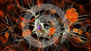 Neurons in Alzheimer's disease