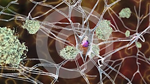 Neurons in Alzheimer's disease