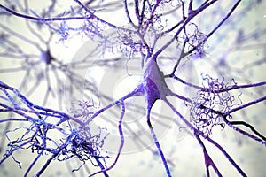 Neurons in Alzheimer's disease