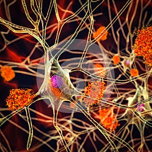 Neurons in Alzheimer's disease. 3D illustration