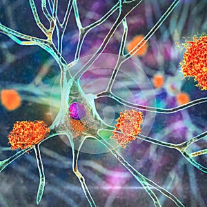 Neurons in Alzheimer's disease. 3D illustration