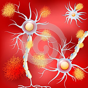 Neurons in the brain with Alzheimer`s disease, and amyloid plaques