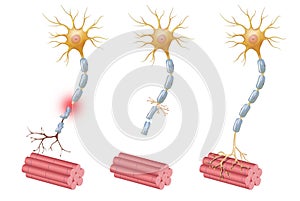 Neuroregeneration refers to the regrowth or repair of nervous tissues, cells or cell products. Peripheral Neuropathy illustration