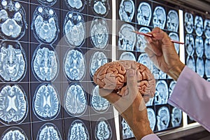 A neurosurgeon holding brain model and pointing at brain MRI photo