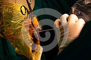 Neurosurgeon performing stereotactic biopsy in operating room