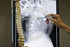 A neurosurgeon pointing at cervical spine x-ray