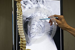 A neurosurgeon pointing at cervical spine x-ray photo