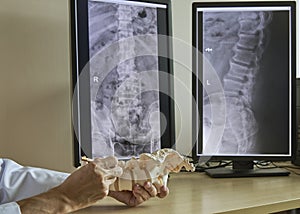 A neurosurgeon pointing at lumbar vertebra model in medical off