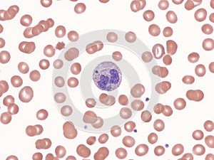 Neutrophil with Howell-Jolly body-like karyopyknotic cytoplasmic inclusion.