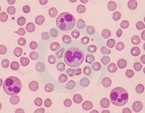 Neutrophil with red blood cells.