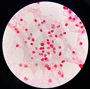 Neutrophil in synovial fluid inframatory cells