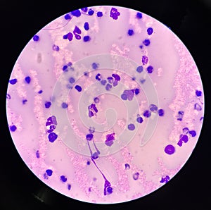 Neutrophil in synovial fluid inframatory cells