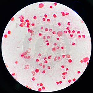 Neutrophil in synovial fluid inframatory cells