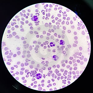 Neutrophil with toxic granulation and vacuole