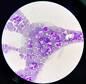 Neutrophil with toxic granulation and vacuole photo