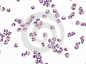 Neutrophils in cerebrospinal fluid.