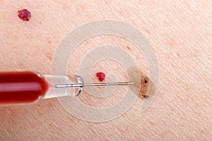 Nevus and cherry angioma on human skin