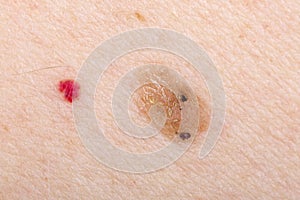 Nevus and cherry angioma on human skin