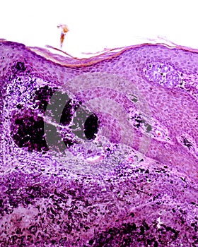 Intradermal pigmented nevus photo