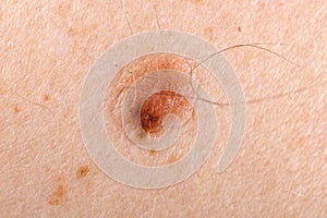 Nevus on human skin
