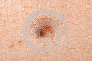 Nevus on human skin