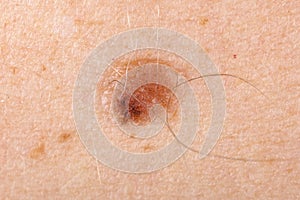 Nevus on human skin photo