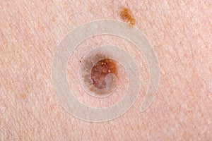 Nevus on human skin