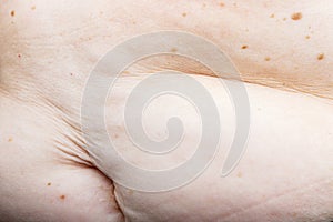 Nevus on human skin, obesity