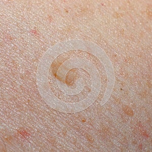 Nevus or mole on the human body closeup. Skin cancer, keratosis or melanoma on the skin