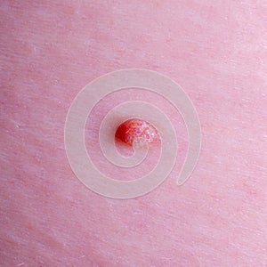 Nevus or mole on the skin of adult