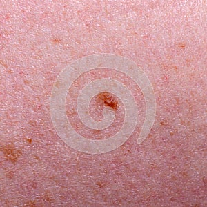 Nevus or mole on the skin of adult