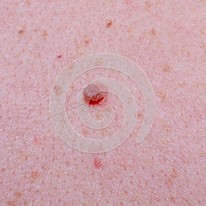 Nevus or mole on the skin of adult