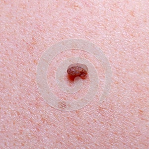 Nevus or mole on the skin of an adult