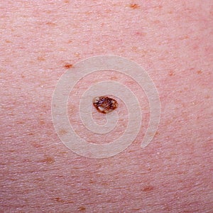 Nevus or mole on the skin of an adult