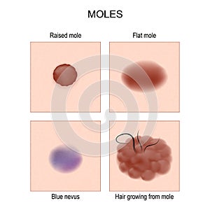 Nevus or mole types. check nevus photo