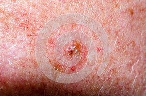 Nevus or papilloma or mole or melanoma or keratosis on the skin of adult