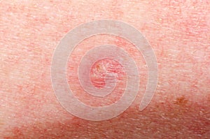 Nevus or papilloma or mole or melanoma or keratosis on the skin of adult