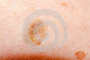 Nevus or papilloma or mole or melanoma or keratosis on the skin of an adult