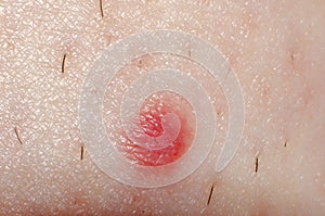 Nevus or papilloma or mole or melanoma on the skin of an adult