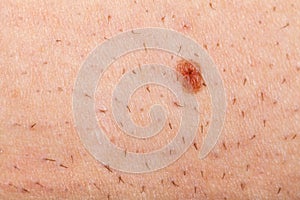 Nevus on a shaved human skin