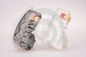New white ceramic tooth with dentures on a light background