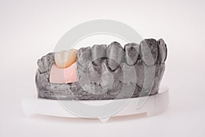 New white ceramic tooth with dentures on a light background